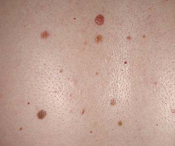 picture of skin with atypical mole structures.